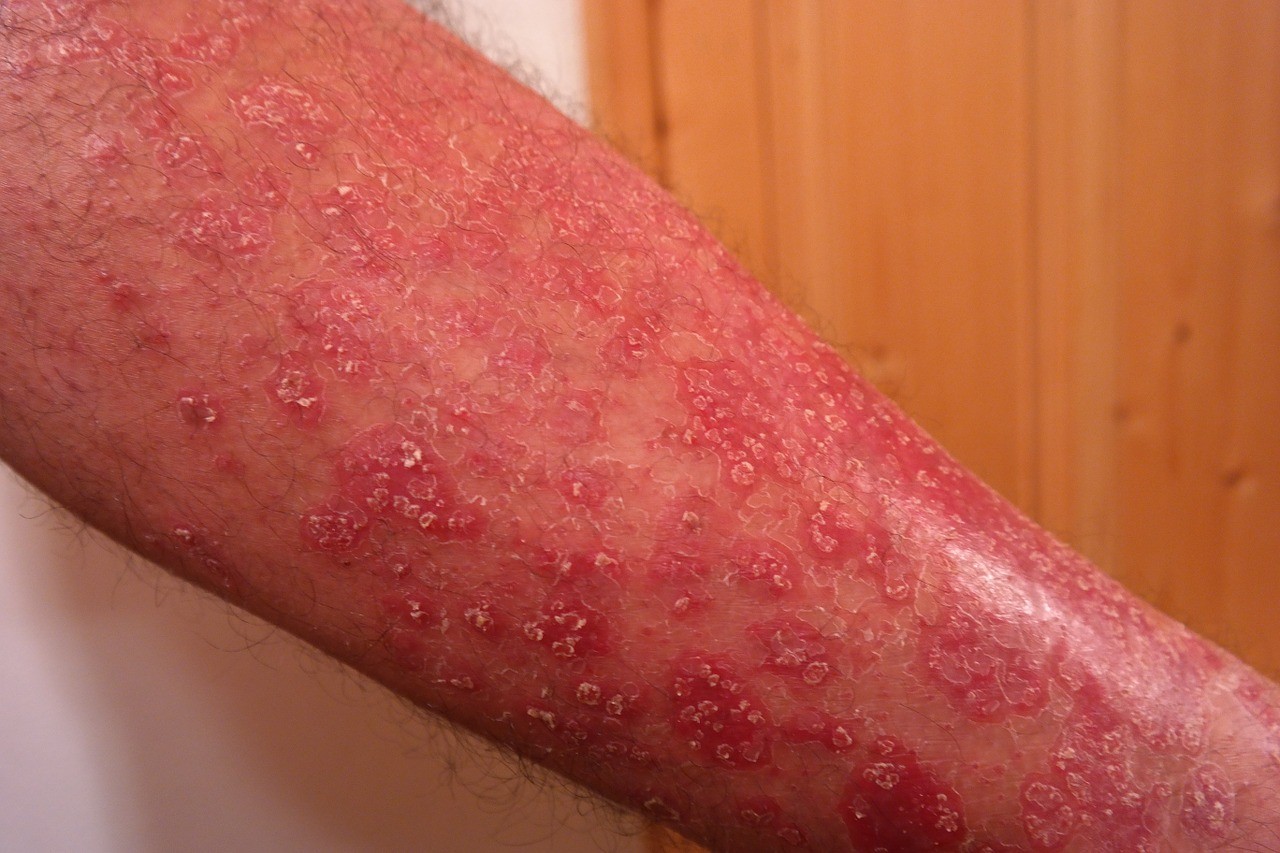 eczema skin